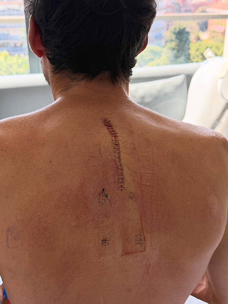 espargaro motogp injury